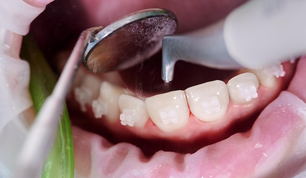 Zbliżenie Obraz Ust Kobiety Podczas Zabiegu Dentystycznego Czyszczenia Zębów