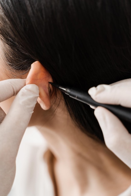 Zbliżenie oznaczenia otoplastyki przed operacją ucha Chirurg rysuje oznaczenie na uchu przed operacją kosmetyczną otoplastyki Oznaczenie otoplastyki do chirurgicznego przekształcania małżowiny usznej i ucha