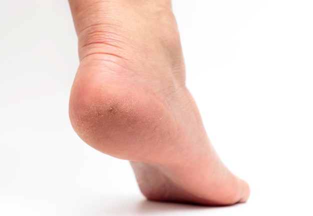 Zbliżenie pięty kobiecej stopy z problematyczną suchą skórą i pęknięciami skóry Koncepcja dermatologicznego leczenia chorób skóry stóp nadczynność paznokci gruczołów potowych