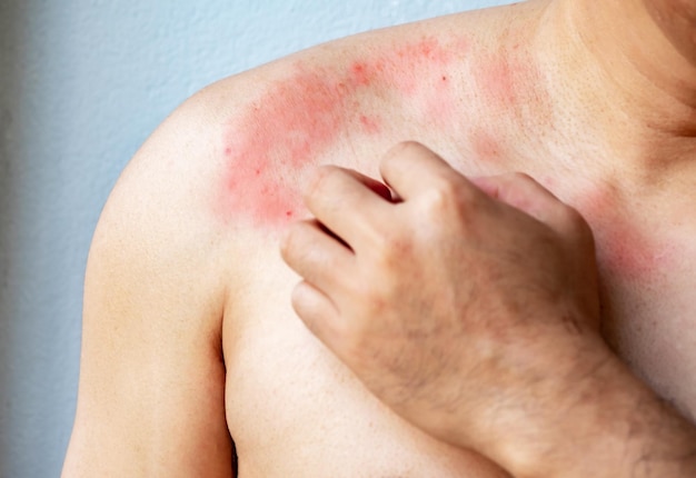 Zdjęcie zbliżenie ręka mężczyzny drapiąca swędzącą skórą na ciele na klatce piersiowej lub swędzenie ramion z powodu wysypki alergia grzybicza choroba dermatologiczna sucha skóra opieka zdrowotna i koncepcja medyczna