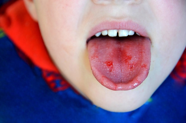 Zdjęcie zbliżenie ust, język, wyłonięcie krwi, ugryziony język dziecka