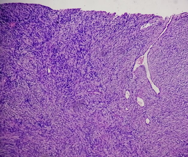 Zdjęcie mikroskopowe nerwiaka osłonkowego łagodnego guza tkanek miękkich pochewki nerwów obwodowych