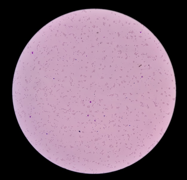 Zdjęcie mikroskopowe niedokrwistości leukoerytroblastycznej z 4x