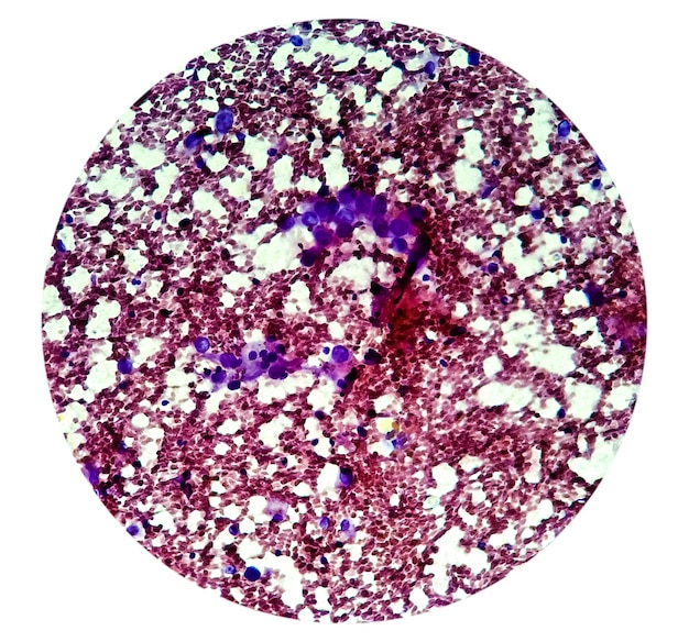 Zdjęcie przedstawiające gruczolakoraka pęcherzyka żółciowego. Rak pęcherzyka żółciowego. Test FNAC, laboratorium histologiczne
