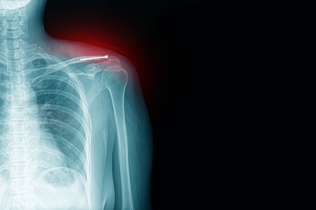 Zdjęcie rentgenowskie bólu barku ze złamaniem obojczyka z pooperacyjną i śrubową koncepcją opieki zdrowotnej. kopia miejsca
