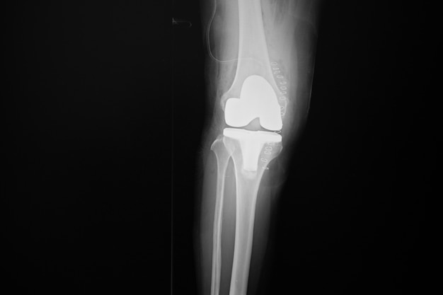 Zdjęcie rentgenowskie lanteroposterior (po prawej) stawu kolanowego z całkowitym zastąpieniem kolana.
