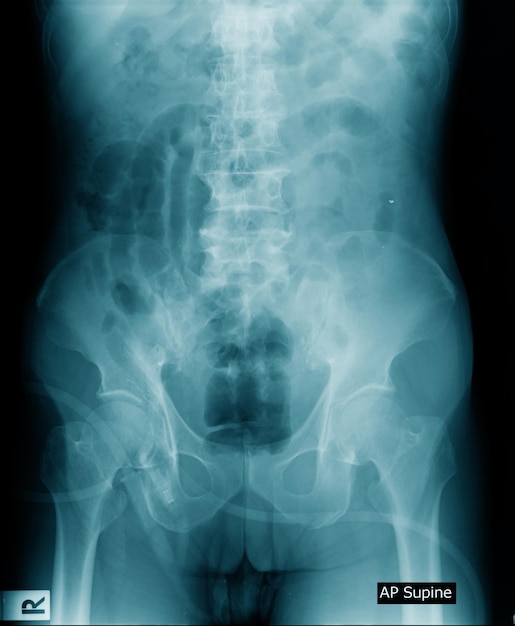 Zdjęcie rentgenowskie przedstawia kość miednicy i kręgosłup