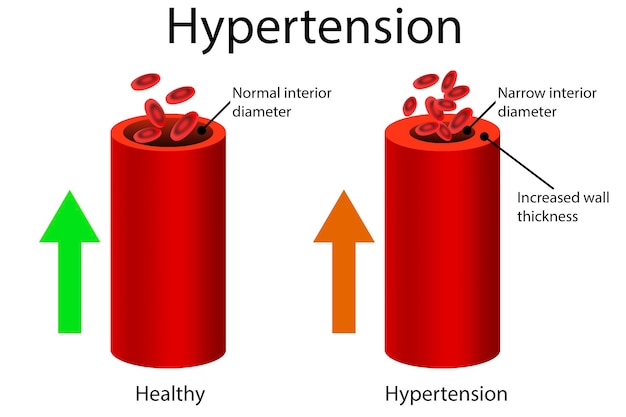 Zdrowe i nadciśnieniowe naczynie krwionośne