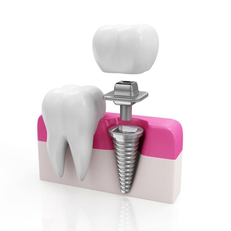 Zdjęcie zdrowie implant dentystyczny i ząb