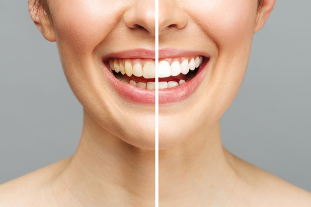 Zęby Kobiety Przed I Po Wybielaniu. Na Białym Tle. Pacjent Kliniki Stomatologicznej. Obraz Symbolizuje Stomatologię Jamy Ustnej, Stomatologię.