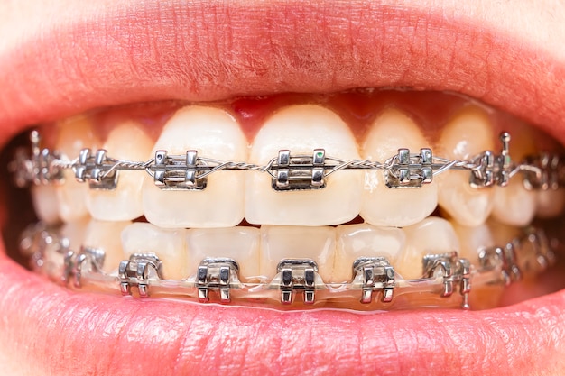 Zdjęcie zęby pierwszego planu z aparatami ortodontycznymi