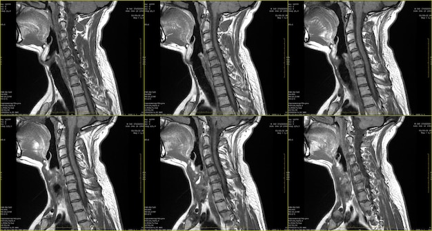 Zdjęcie zestaw 6 skanów mri strzałkowej okolicy szyi mężczyzny rasy kaukaskiej w wieku 34 lat z obustronną przyśrodkową ekstruzją segmentu c6c7 z radikulopatią