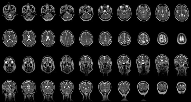 Zestaw seryjnych skanów MRI głowy kobiety rasy kaukaskiej w wieku sześćdziesięciu lat w płaszczyźnie czołowej i poziomej