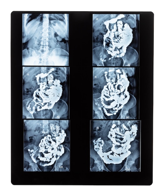 Zestaw zdjęć rentgenowskich z badaniami barytu jelita cienkiego