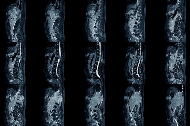 Zwężenie kręgosłupa lędźwiowego Skan MRI Widok strzałkowy stwierdzający umiarkowany tylny dolny występ guza powoduje obustronny ucisk korzenia. Przewlekła choroba bólu krzyża