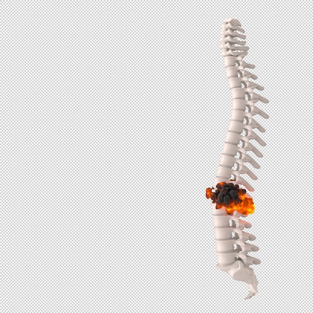 Human spine with disc herniation concept