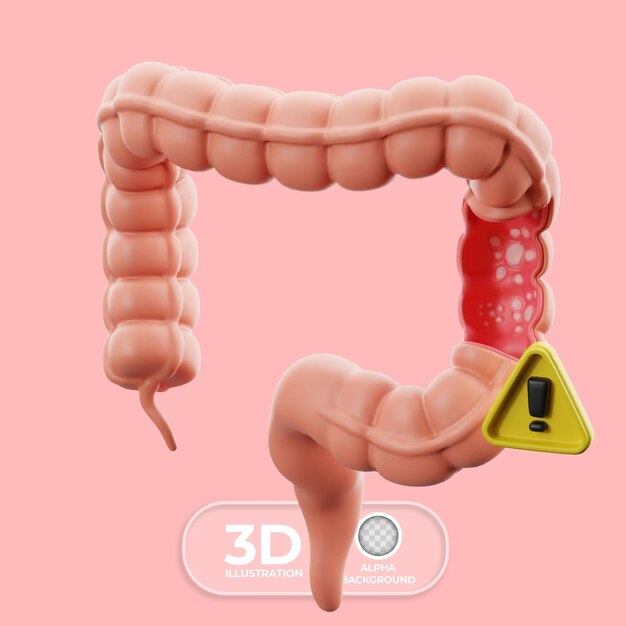 Colitis ulcerosa con señales de advertencia Ilustración en 3D