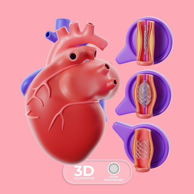 Ilustración 3D del cateterismo para la enfermedad cardíaca