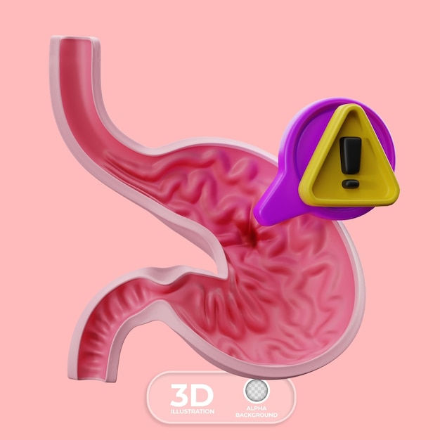 Ilustración 3D del signo de la úlcera péptica
