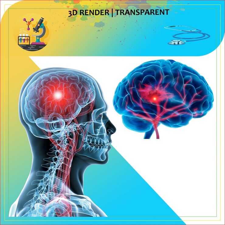 PSD anatomía del cerebro pulmones humanos neurología pulmones infección cuerpo dolor cabeza dolor neurocirugía enfermedad