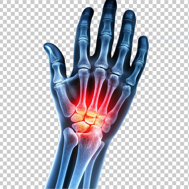 PSD arthrite rhumatoïde ou gouttière x-ray de la main humaine 39s vue oblique douleur à la main sur un fond transparent