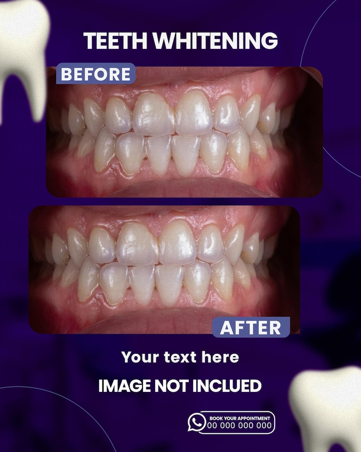 PSD blanqueo de dientes antes y después