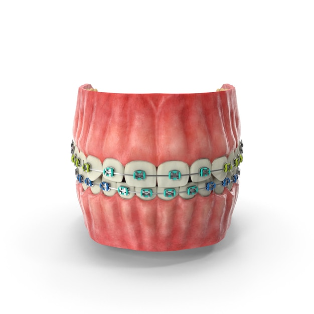 Boca humana 3D realista com aparelhos dentários de aço Arquivos PSD de design ortodôntico de alta qualidade