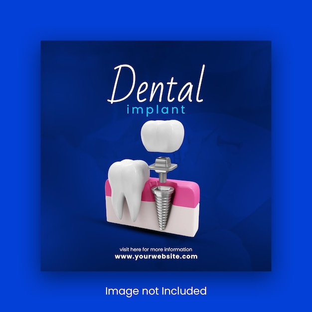 PSD cartel de implantes dentales