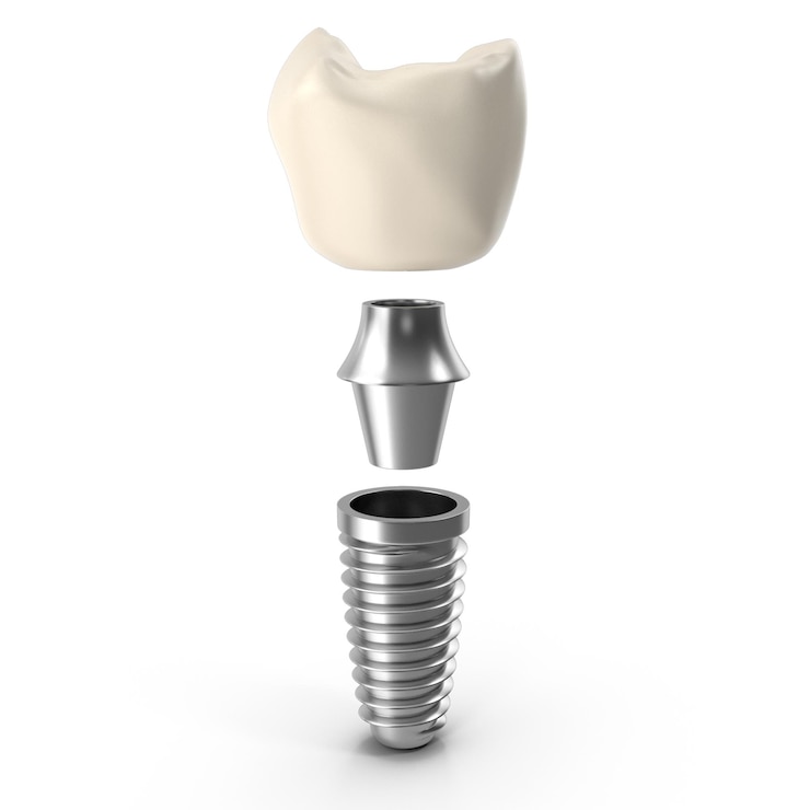 PSD componentes de los implantes dentales