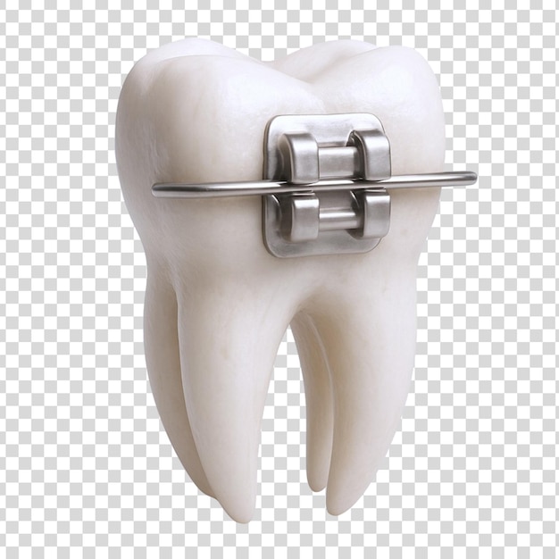 Une dent avec un appareil orthodontique
