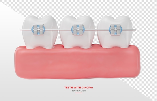 Dentes com aparelhos dentários nas gengivas em renderização 3d com fundo transparente