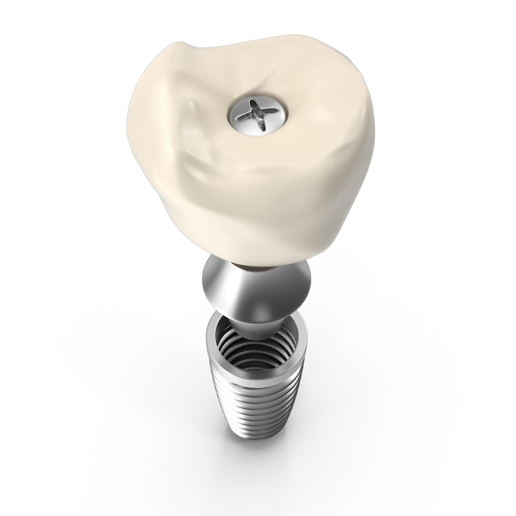 PSD implantos dentales con corona