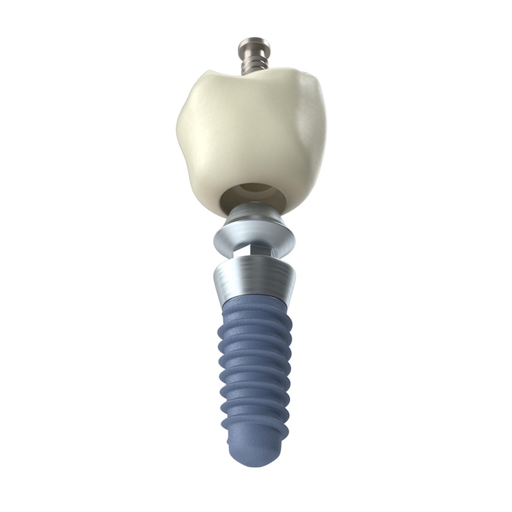 PSD implantos dentales con corona
