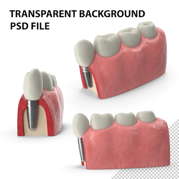 Modello di impianto dentale educativo PNG