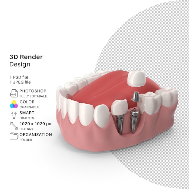 PSD mundimplantatmodell 3d rendern