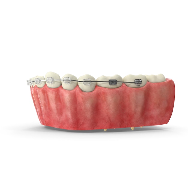 Realistica mascella inferiore umana 3D con apparecchi dentali trasparenti File PSD dettagliati ortodontici e medici