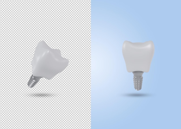 Renderizado en 3D de un implante dental y un diente artificial