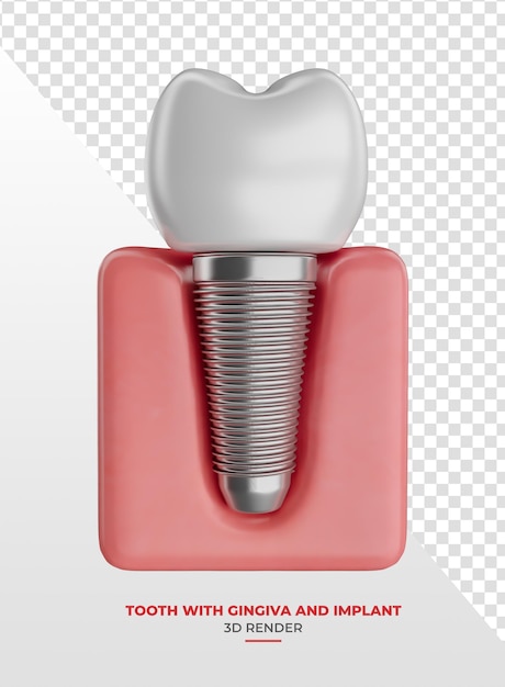 teeth with implants in 3d render with transparent background