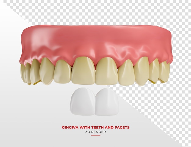 Zahnfleisch mit gelben Zähnen und Veneer in 3D-Rendering mit durchsichtigem Hintergrund