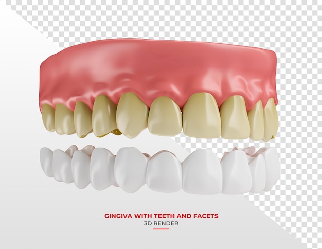 Zahnfleisch mit gelben Zähnen und Veneer in 3D-Rendering mit durchsichtigem Hintergrund
