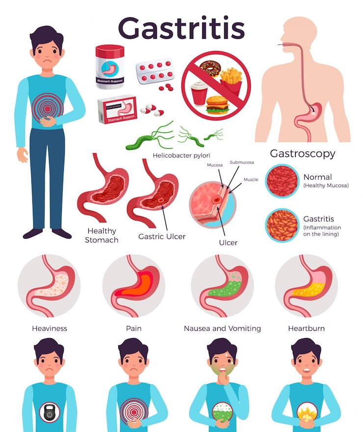 Ücretsiz Vektör gastrit gerçekleri – sağlıksız gıda bakterileri, mide rahatsızlıkları, gastroskopi ve ilaçlarla ilgili hastalık üzerine düz infografik öğeleri