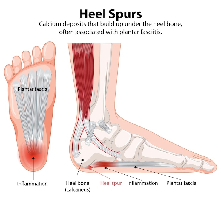 Ücretsiz Vektör heel spurs and plantar fasciitis