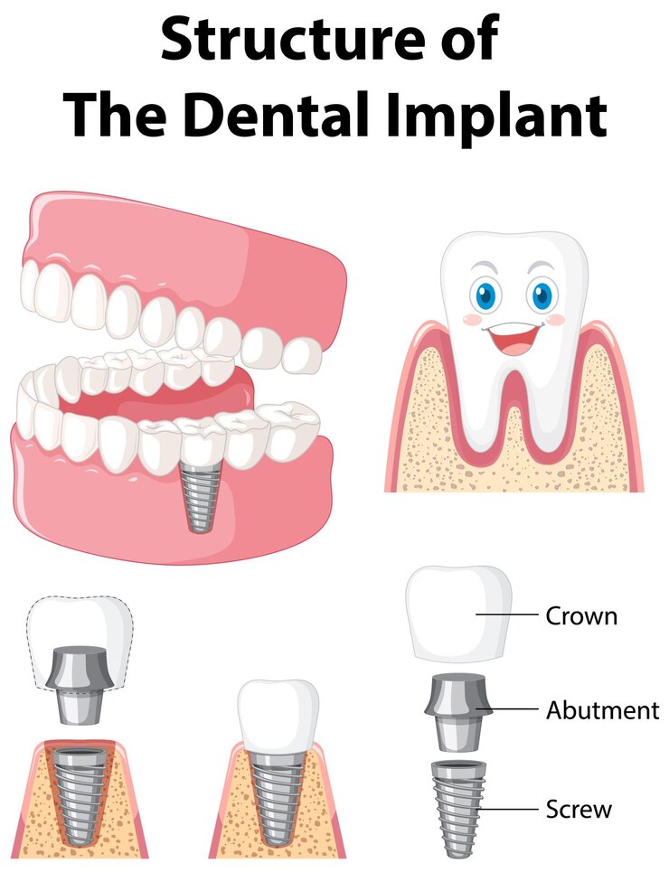 Ücretsiz Vektör i̇nsan vücudunda dental implant yapısının infografiği