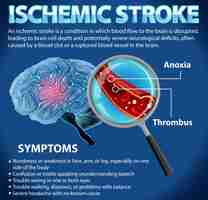 Vecteur gratuit affiche informative de l'avc ischémique