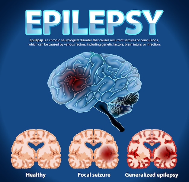 Vecteur gratuit affiche informative sur l'épilepsie