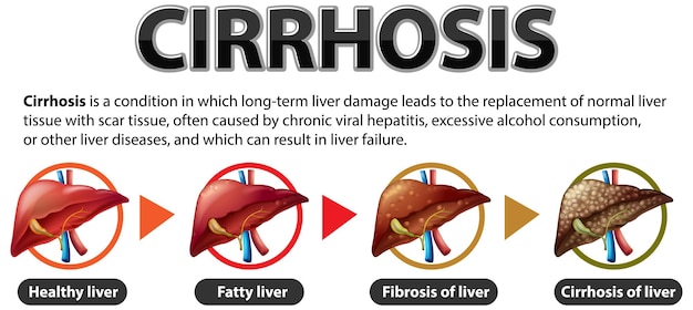 Vecteur gratuit affiche informative sur la maladie alcoolique du foie cirrhose