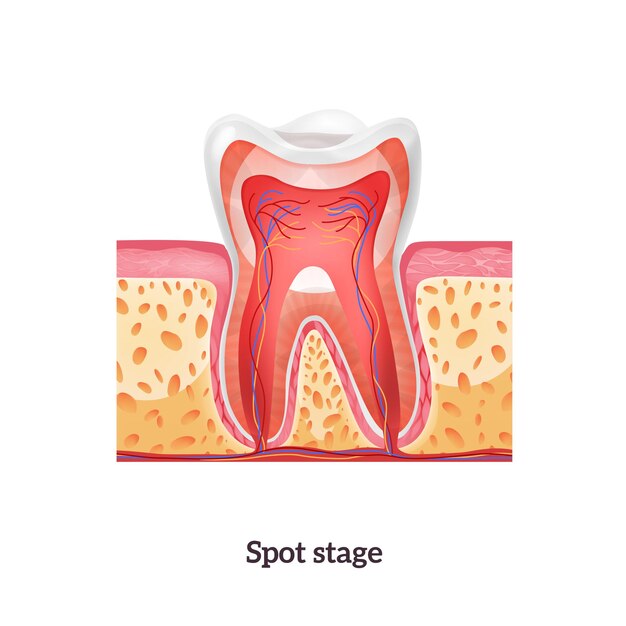 Anatomie dentaire avec stade ponctuel de la carie