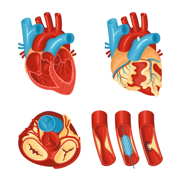 Vecteur gratuit anatomie du coeur sain et malade ensemble plat isolé sur illustration vectorielle fond blanc