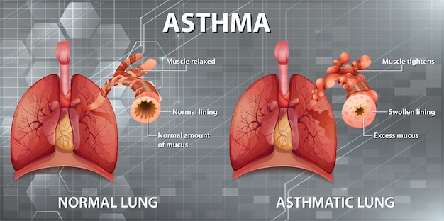 Anatomie Humaine Diagramme De L'asthme