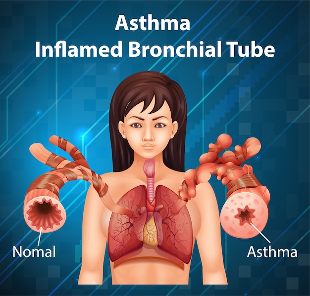 Anatomie Humaine Diagramme De Tube Bronchique Enflammé D'asthme